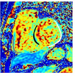 Short-axis T1 map in an adult with repaired tetralogy of Fallot