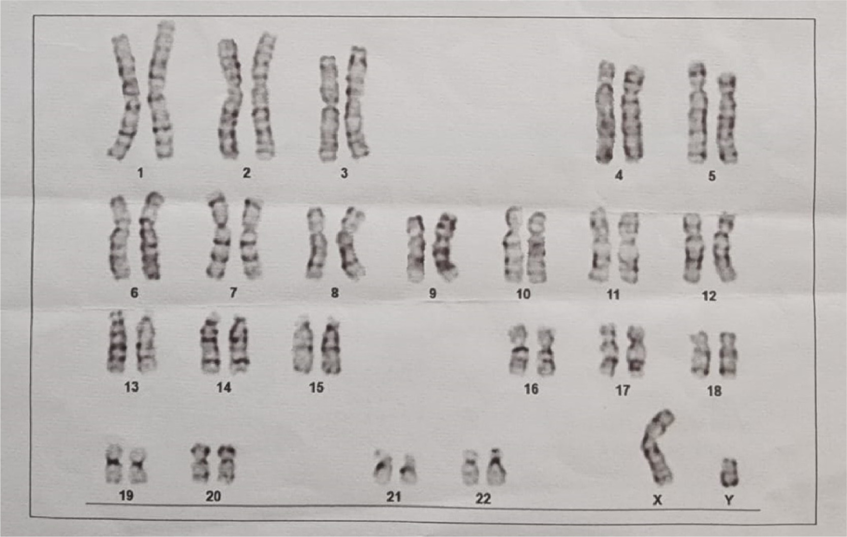 Chromosomal examination revealed a 46XY karyotype pattern.