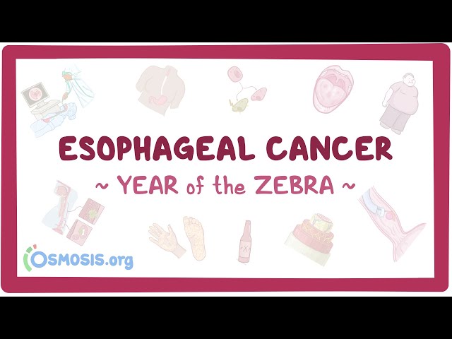 Esophageal Cancer