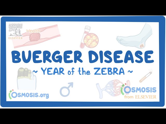 Rare Disease Education: Buerger Disease