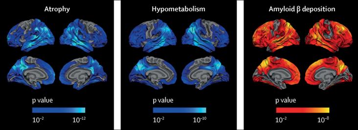  Imaging signature of Alzheimer's disease in adults with Down syndrome for brain structure, glucose metabolism, and amyloid β deposition.