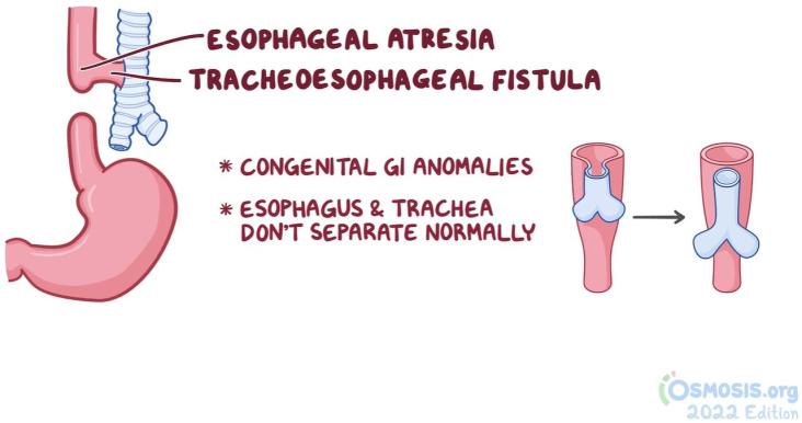Diagram of Esophageal Atresia & Tracheoesophageal Fistula