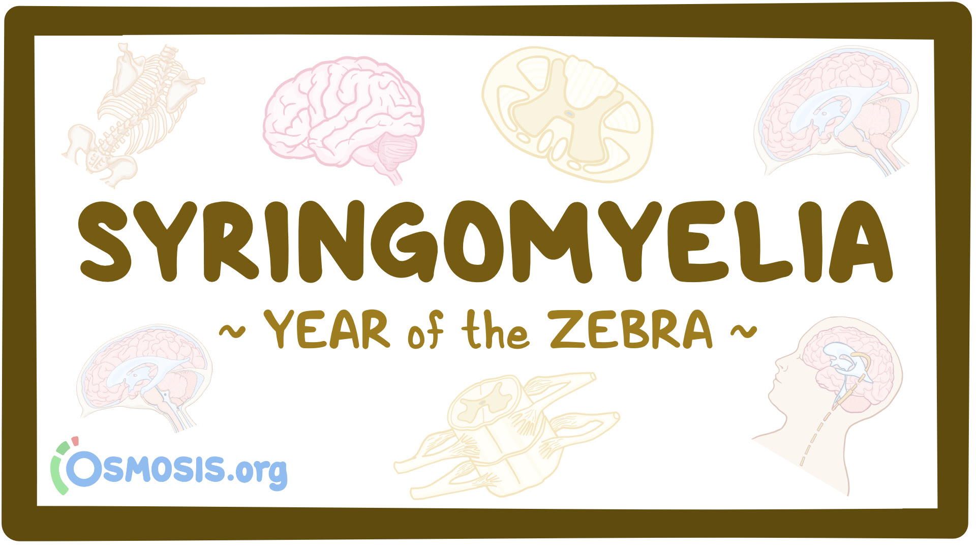 Syringomyelia